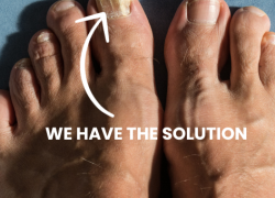 Bid Farewell to Toenail Fungus from the Comfort of Your Home